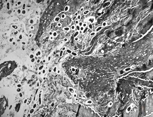 M,57y. | dermatomycosis M,57y. | dermatomycosis